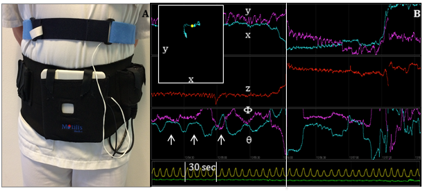 3D-Transit system. A. Sensors in the detector plate register electromagnetic signals from the ingested capsule. A chest worn respiration belt registers artifacts due to respiration. B. Graphs displaying position (x, y, z) and orientation (, ) of the capsule when passing the GI tract. Upper left window shows capsule position in x-y direction according to the external monitor. Arrows mark the contraction frequency of 3 per minute, characteristic of the stomach. Vertical line marks the shift in capsule position from stomach to small intestine. Yellow line marks respiration. Green line marks accelerometer. 