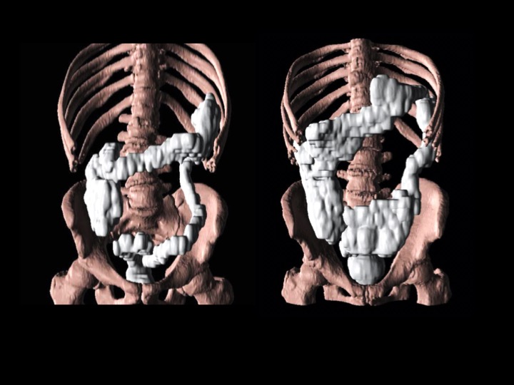 Colonic volume in a healthy control subject (left) and a PD patient with severely increased volume (right).